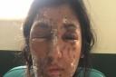 Resham Khan had acid thrown on her and her cousin. PICTURE: Resham Khan/GoFundMe